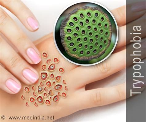 Holes In Skin Disease
