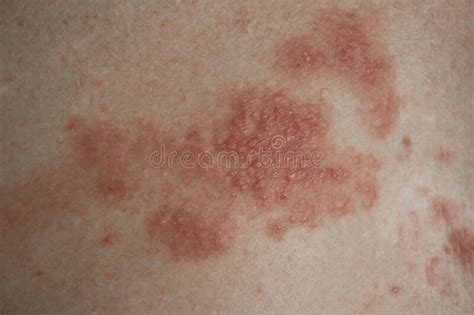 Eczema Malattia Del Paziente Psoriasi Dermatologia Genetica Sulla