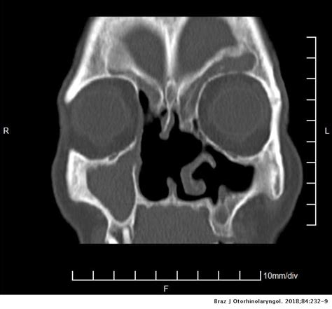Giant Fronto Ethmoidal Osteoma Selection Of An Optimal Surgical
