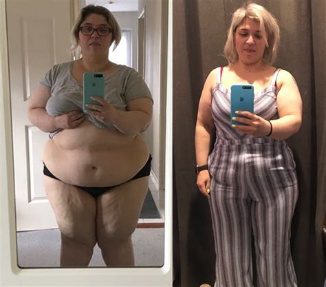 Weight Loss Surgery Before After Photos Nordbariatric Clinic