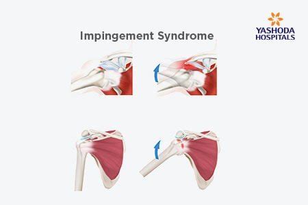 Shoulder Impingement What Is Shoulder Impingement Its Causes