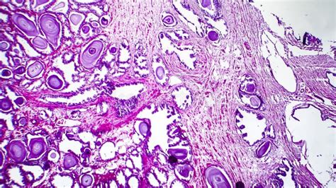 Histopatologia Da Hiperplasia Da Glândula De Próstata Foto de Stock Imagem de glândula