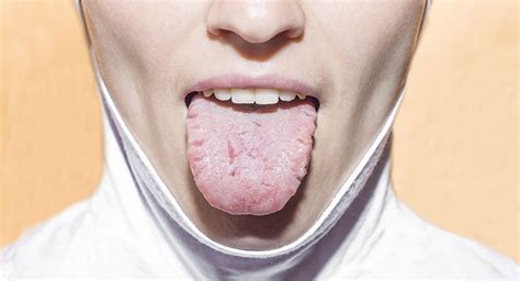 Geographic Tongue Causes And Treatments Smile Works Dental