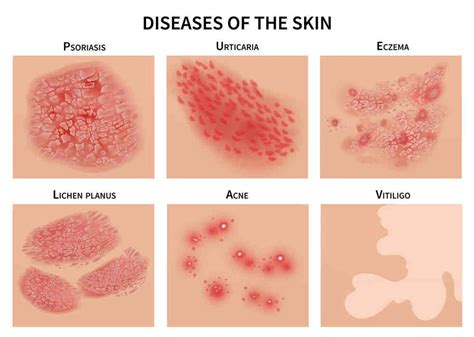 Types Of Skin Diseases Types Of Skin Diseases Types Of Some