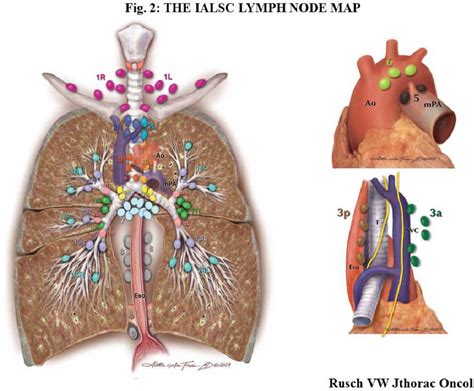Pulmonary Lymphatic Drainage In Non Small Cell Lung Cancer Semantic