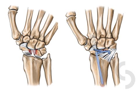 Ligament has 19 translations in 9 languages. Wrist Ligament Injuries - dr Sonja Cerovac