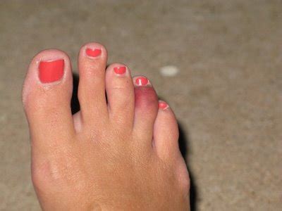 Your broken toe stock images are ready. ZeroPoint Global The Current #205