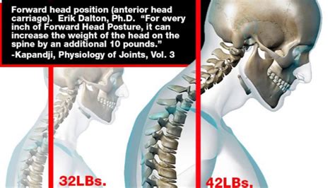 Forward Head Posture Texting Causes Neck And Upper Back Pain Pinched