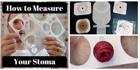 How To Measure Your Stoma Ostomy Tips Veganostomy Stoma Ostomy