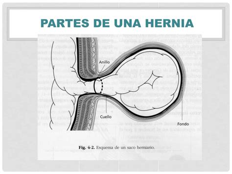 Como Es La Operacion De La Hernia Inguinal Ideas Of Europedias