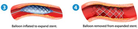 stent procedure 2 vascular care wa