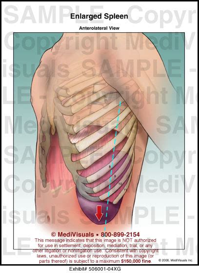 Enlarged Spleen Medical Illustration Medivisuals