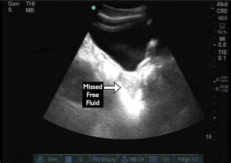 Tips And Tricks For The Pelvic Views During The Fast Exam —