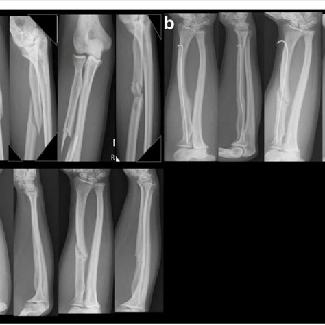 A 35 Year Old Male Sustained A Left Radio Ulnar Shaft Fracture From A