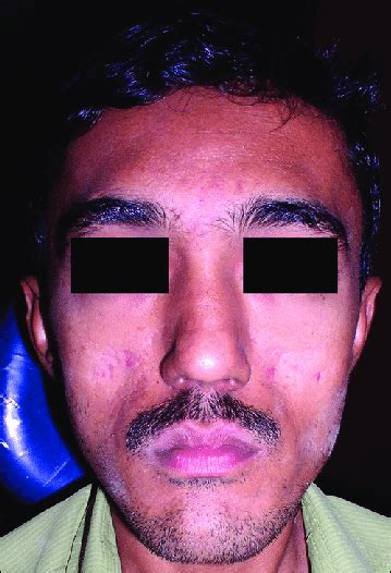 Clinical Image Showing Flattening Of Right And Left Cheek Download