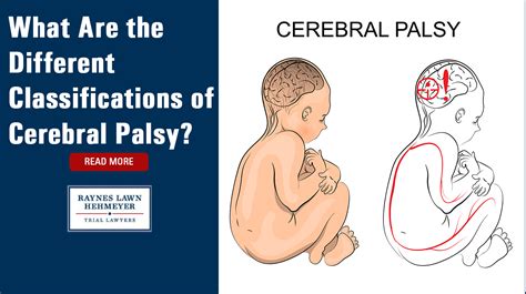 What Are The Different Classifications Of Cerebral Palsy