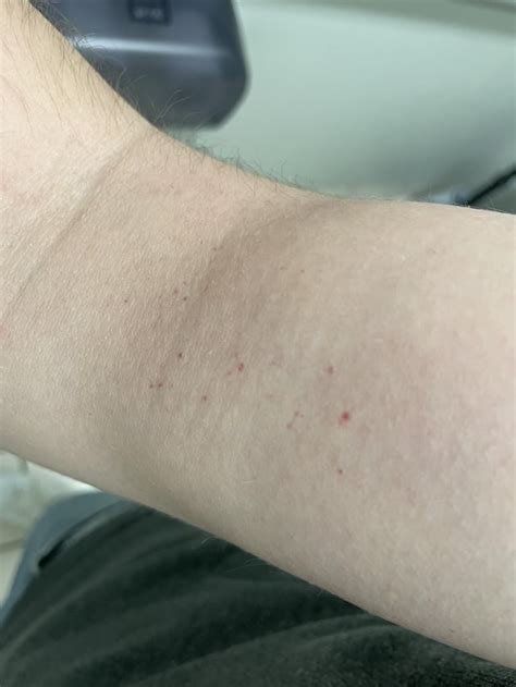 These Red Spots Appeared On My Arms Back And Shoulders After Taking