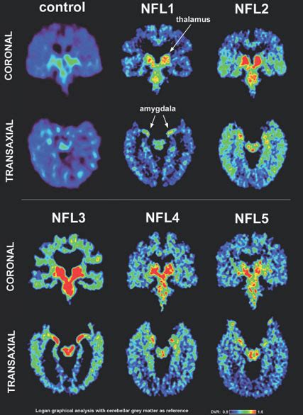 This page is about the various possible meanings of the acronym, abbreviation, shorthand or slang term: The Neurocritic: The Ethics of Public Diagnosis Using an Unvalidated Method