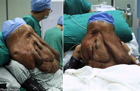 China's 'elephant man' undergoes 3rd op to remove giant ...