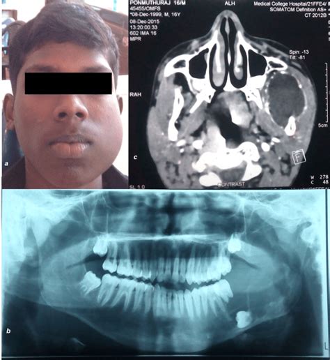 The Extra Oral Photograph A Showing A Unilateral Swelling On The Left