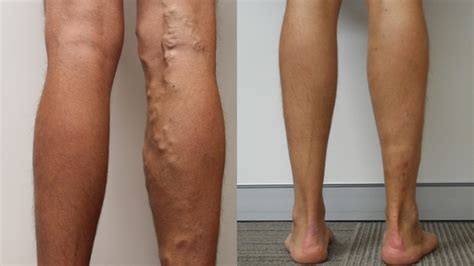 Pictures Of Bruising After Varicose Vein Surgery The Meta Pictures