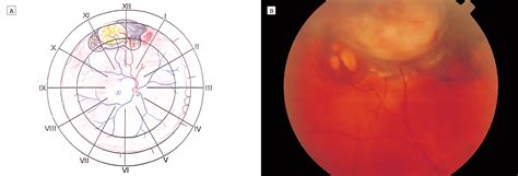 Adenocarcinoma Arising From Congenital Hypertrophy Of Retinal Pigment