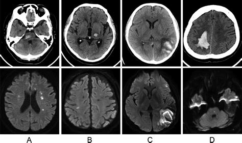 Asymptomatic Acute Ischemic Lesions In Intracerebral Hemorrhage Its