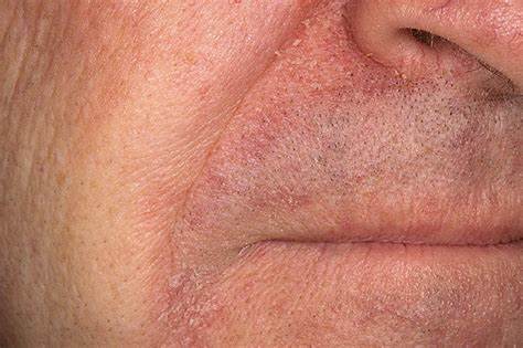 Себорейный дерматит лечение диетой Себорейный дерматит: лечение лекарственными препаратами и народными Себорейный дерматит: лечение лекарственными препаратами и народными Себорейный дерматит лечение диетой