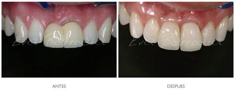 Implantes Dentales Coronas Y Fundas De Porcelana En Bilbao