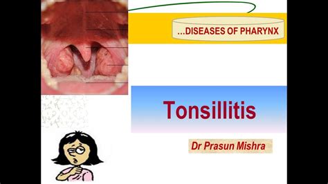 Tonsillitis Basics And Mcqs Asked In Entrance Youtube