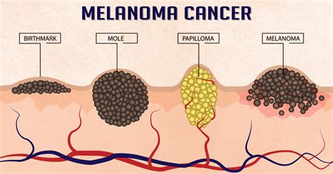 Melanoma Cancer Skin Cancer Health Reactive