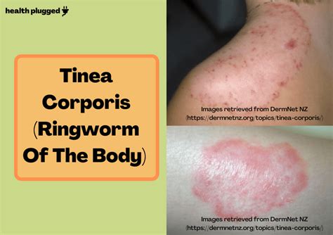 Ringworm Tinea Corporis Treatment