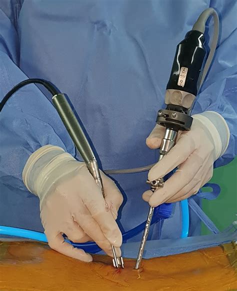 Biportal Endoscopic Technique For Transforaminal Lumbar Interbody
