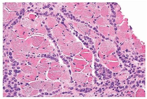 Invasive Lobular Carcinoma Basicmedical Key