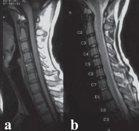 Mid Sagittal T1 A T2 B Weighted MRI Of Cervic Open I