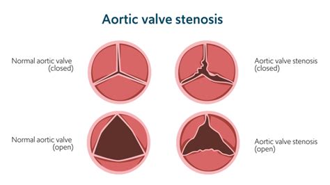 Aortic Stenosis Heart Conditions Rbandhh Specialist Care