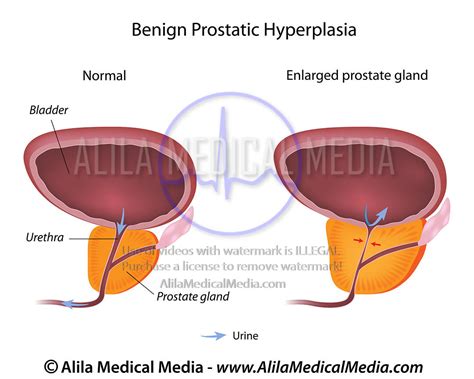 alila medical media benign prostatic hyperplasia bph medical illustration