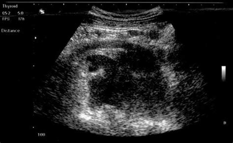 Anaplastic Large Cell Lymphoma Echocardiography Or Ultrasound Wikidoc
