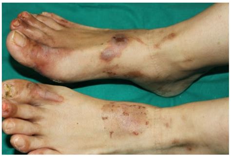 Ijms Free Full Text Paraneoplastic Dermatoses A Brief General