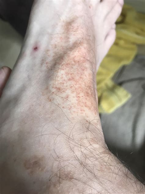 Odd Rash Type Thing Appeared On Each Foot Sometimes Itchy Any Idea
