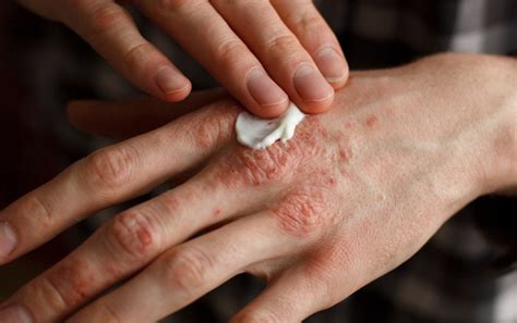 Dermatologists Brighton What Are The Most Common Skin Allergies