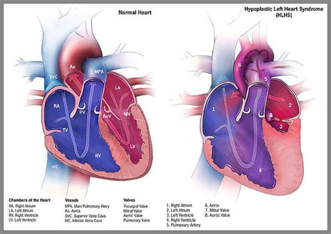 Heart Birth Defects Hypoplastic Left Heart Syndrome