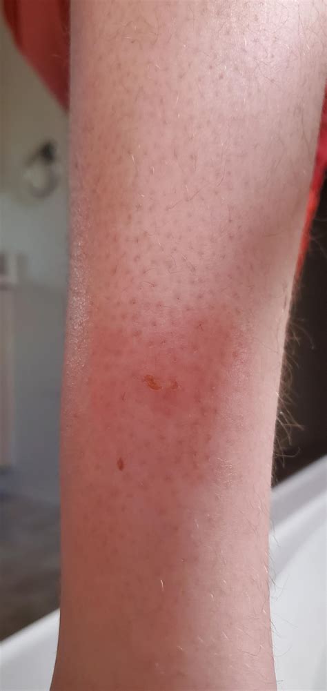 Noticed This Bug Bite Yesterday Its Sorta Swollen And Has Yellow Crap