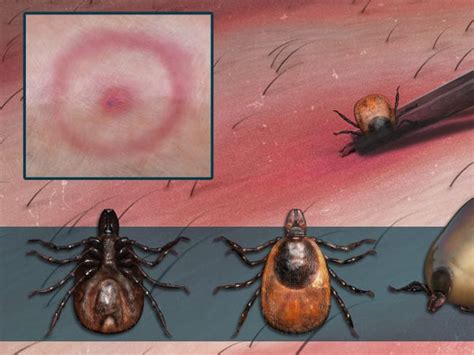 Deer Tick Bite How To Identify And Treat It