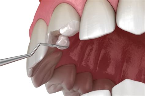 what you need to know about chipped teeth other parker co