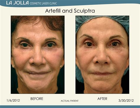 Patient Treated With Artefill And Sculptra At La Jolla Cosmetic Laser