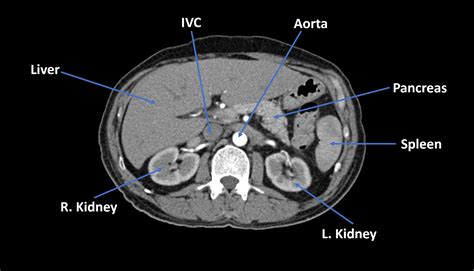 Its superior aperture faces towards the thorax, enclosed by the diaphragm. Radiology for the USMLE: Abdominal Anatomy | Abdominal ...