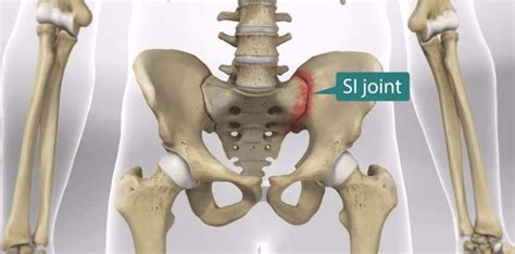 Si Join Recovery Time Spine Surgeons In Tampa Spine Surgeons