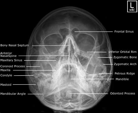 Facial Bones Radiographic Anatomy Wikiradiography