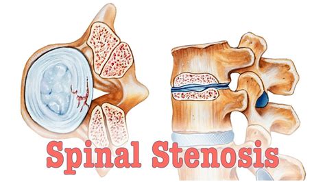 Everything You Need To Know About Spinal Stenosis Spi